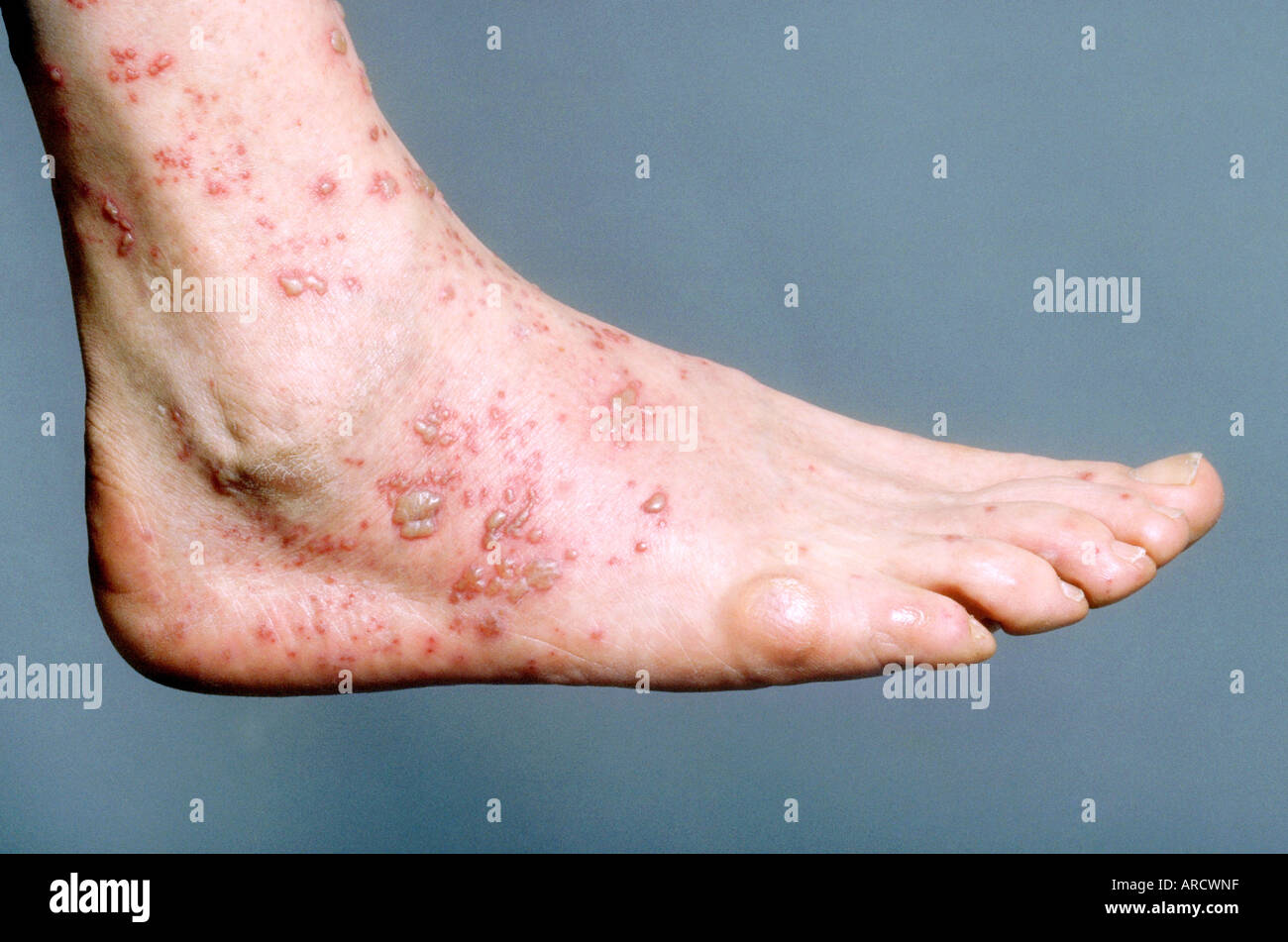 Ein Patient mit einer akuten vesikuläre Entzündung am Fuß durch das  Ansteigen der Windpocken-Virus, Varicella Zoster vi Stockfotografie - Alamy