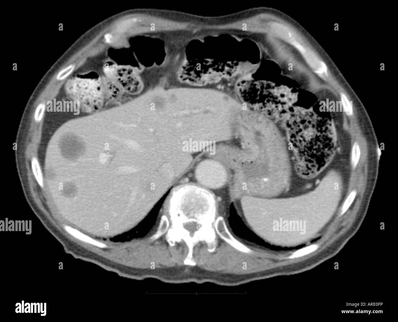 CT-Scan Bild des Bauches zeigt metastatische Läsionen von Prostata-Krebs Stockfoto