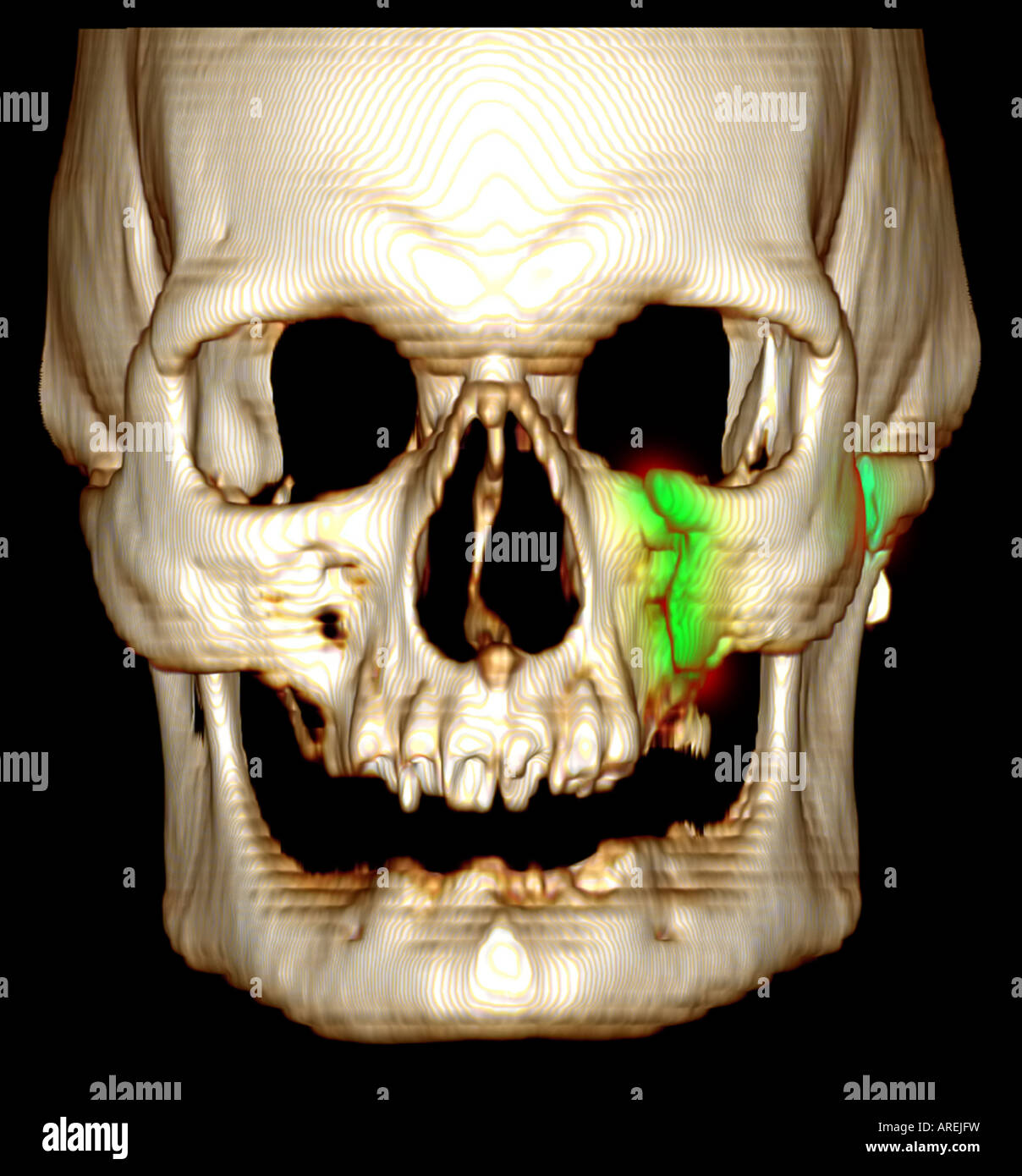 dreidimensionale CT-Scan Rekonstruktion zeigt eine Stativ-Fraktur unter Einbeziehung der Jochbogen und minderwertige Umlaufbahn Stockfoto