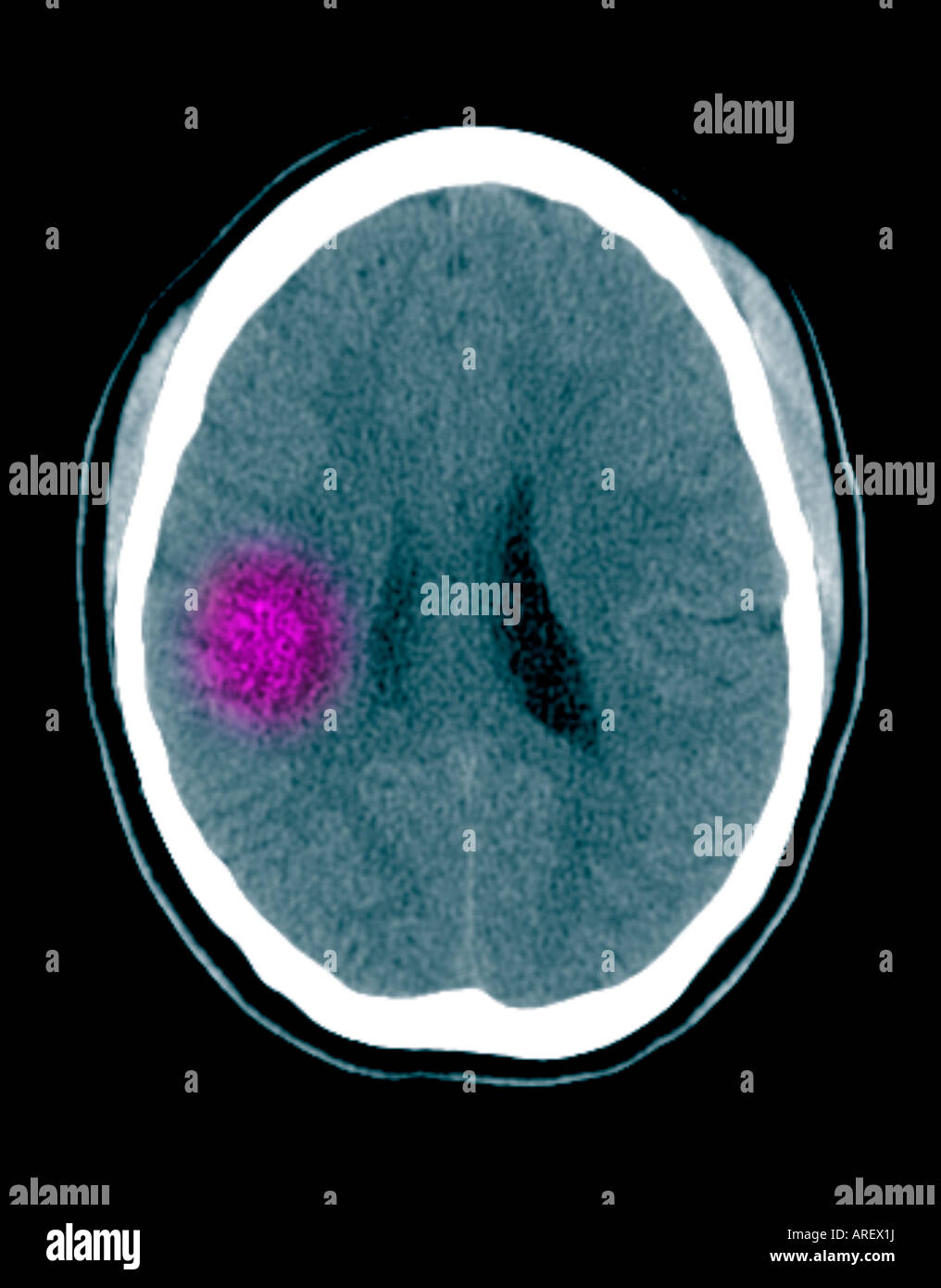 CT-Scan des Gehirns zeigen Lyme Gehirnentzündung Stockfoto