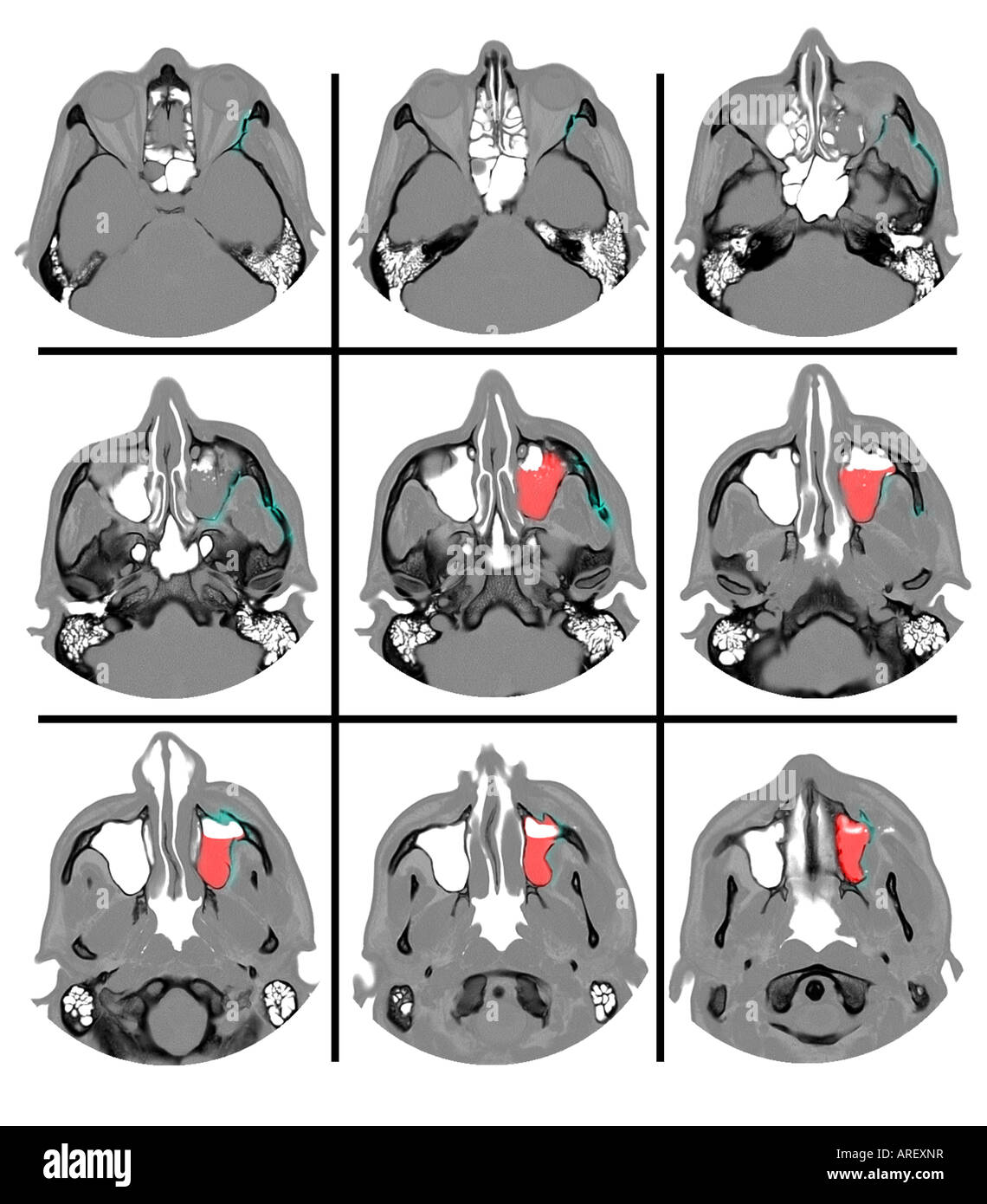 CT-Scan zeigt einen Oberkiefer Bruch Stockfoto