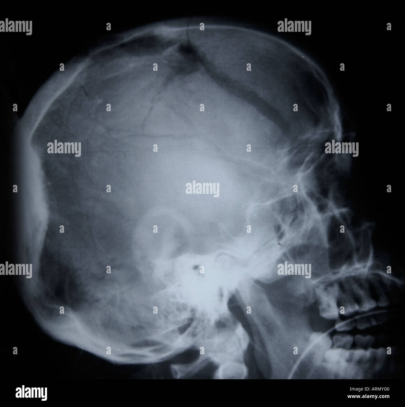 Crosstable seitliche Röntgenaufnahme des Schädels mit großen Bruch Stockfoto