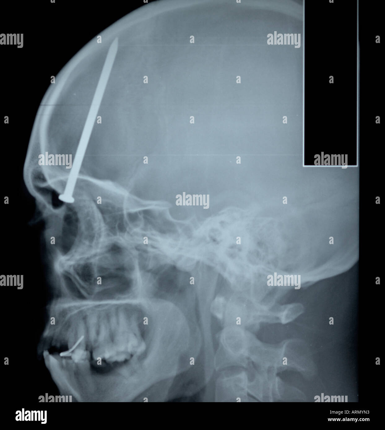 seitliche Röntgenaufnahme des Erwachsenen Schädel Stockfoto