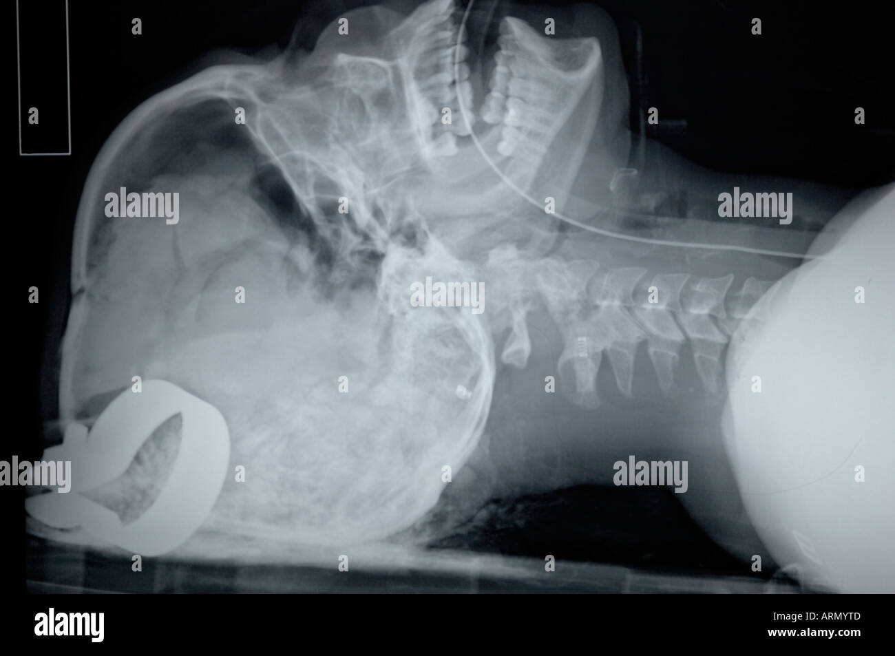 Crosstable seitliche Röntgenaufnahme des Erwachsenen Schädel Stockfoto