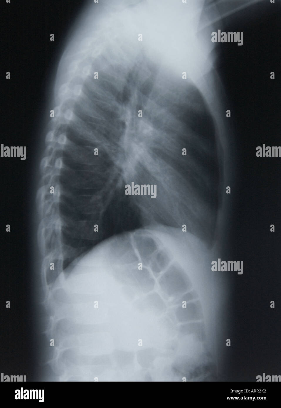 normale seitliche Röntgenaufnahme des juvenilen Brust Stockfoto