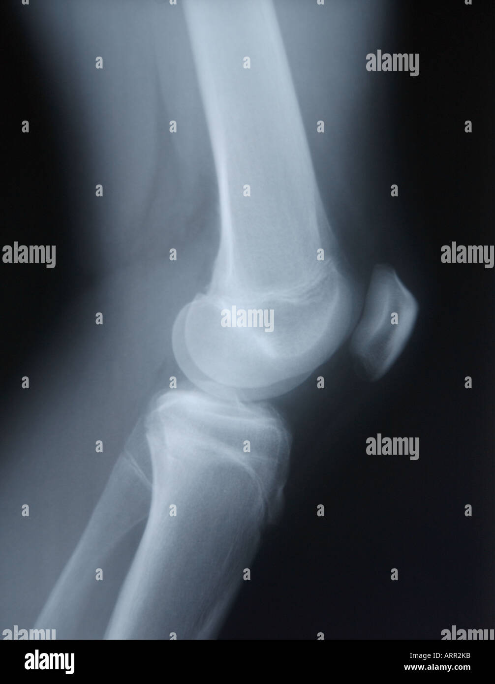 normale seitliche Röntgenaufnahme des juvenilen Knie Stockfoto