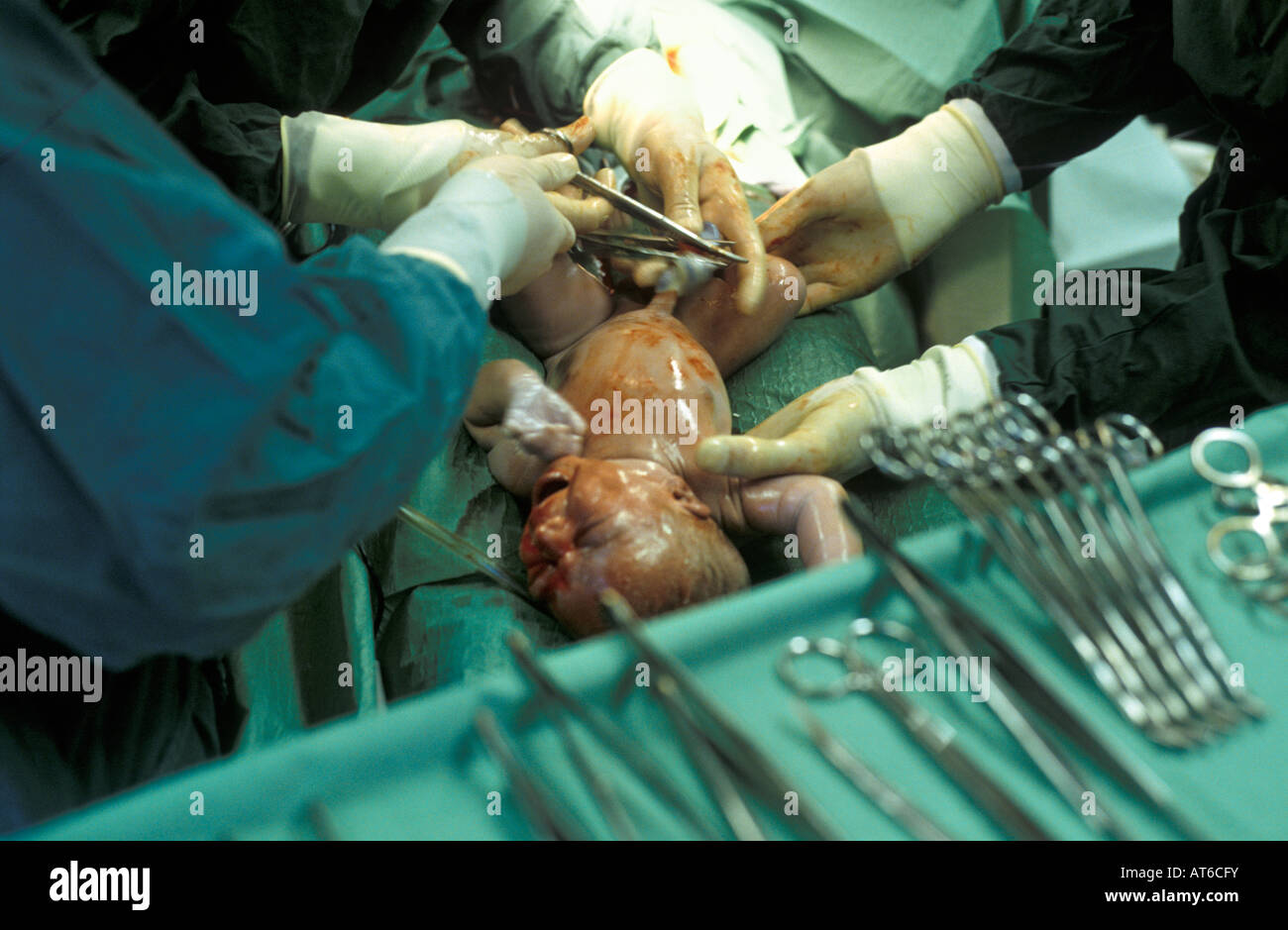 Entbindung im Krankenhaus Stockfoto