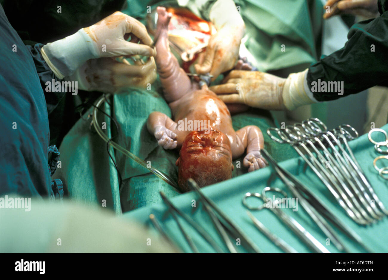 Entbindung im Krankenhaus Stockfoto