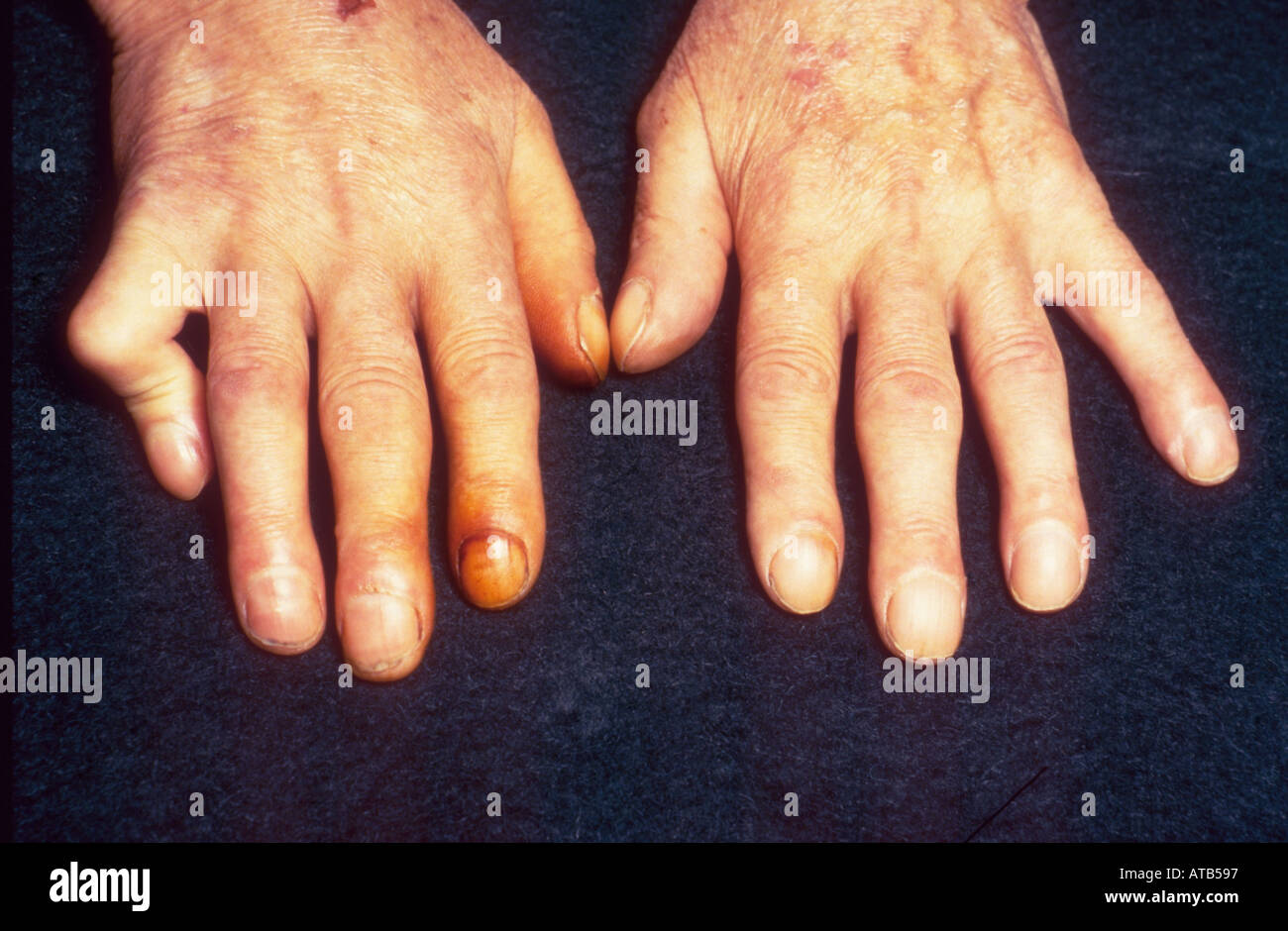 Ca Bronchus Finger clubbing und Nikotin Flecken Stockfoto