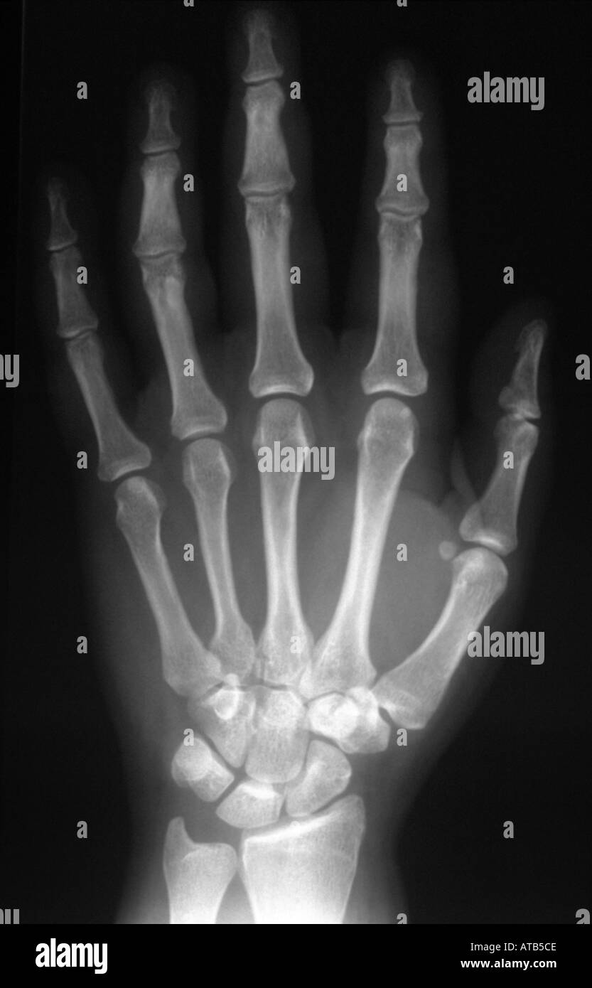 Normal x ray the hand Fotos und Bildmaterial in hoher Auflösung Alamy