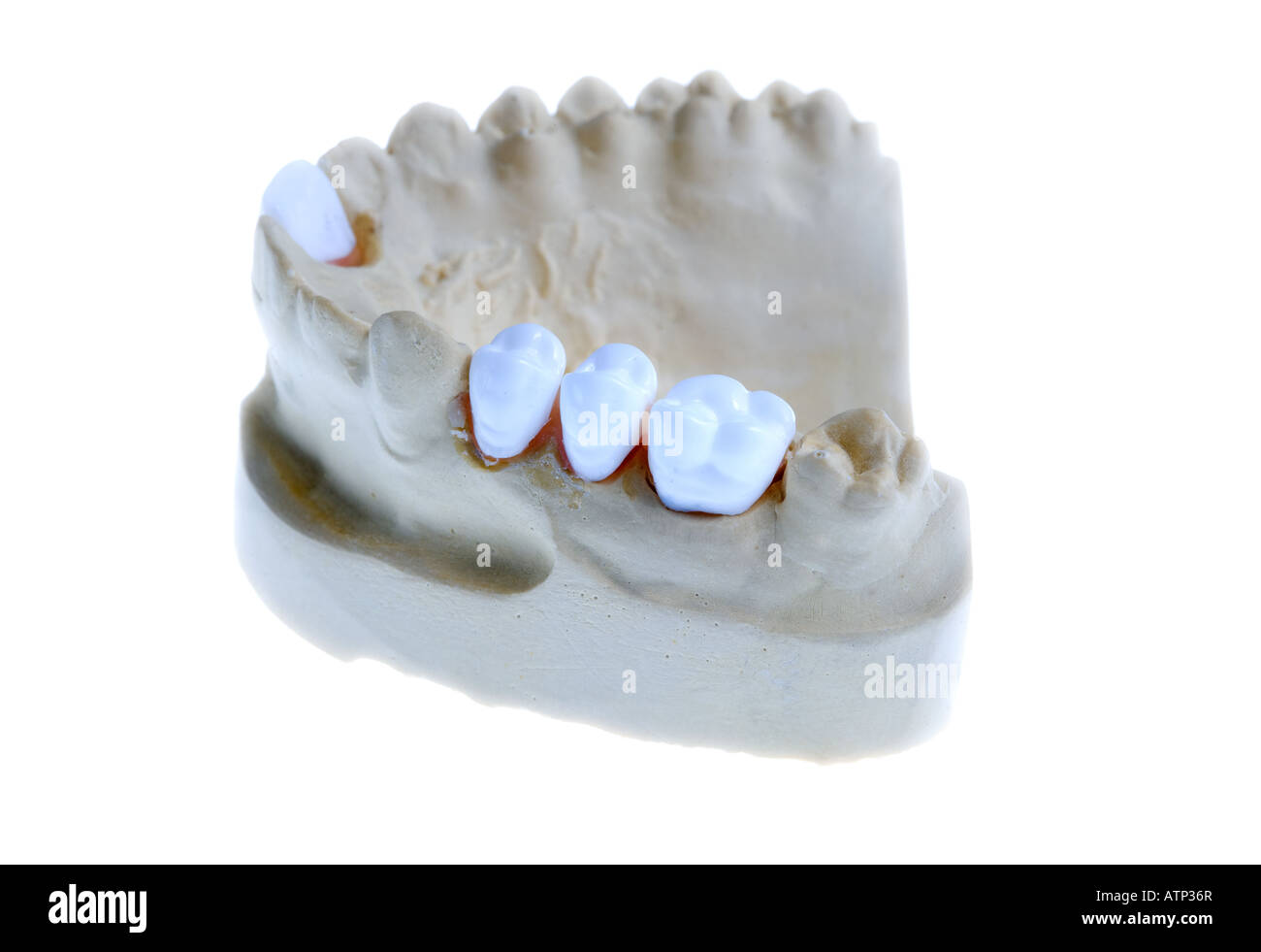 Dental Zahn-Implantate in einer Form von einem Personen-Mund auf weißem Hintergrund Stockfoto