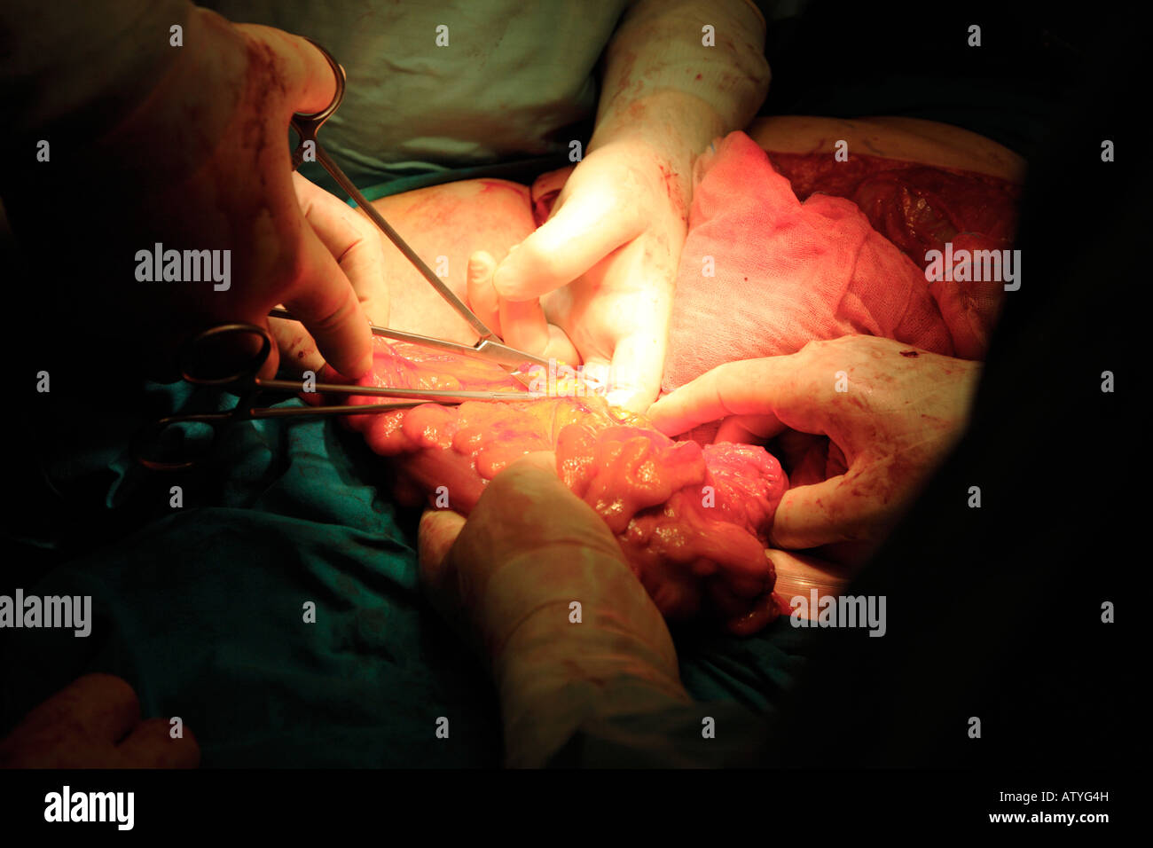 Chirurg schneiden Weg von Gewebe im Colon transversum während der Krebsoperation Stockfoto