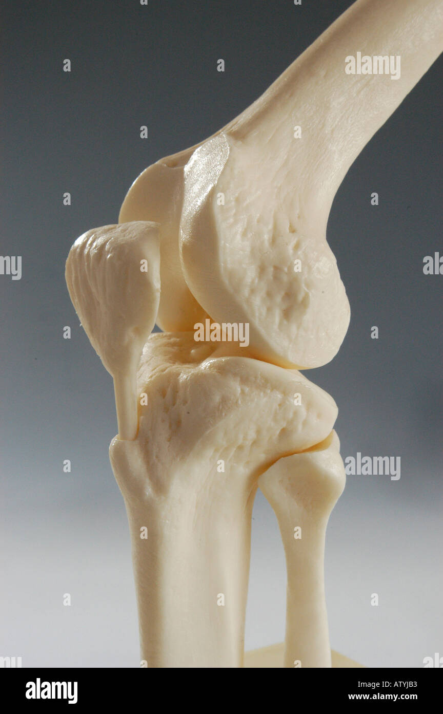Knie-TEP Prothese Gelenk Kuenstliches Kniegelenk Roentgenbild ...