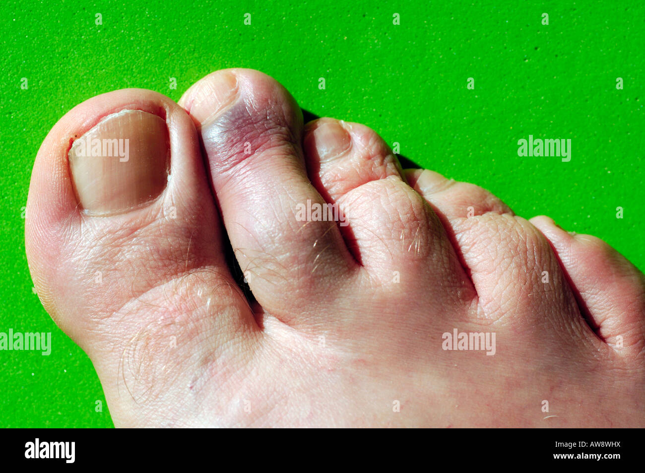 einen rechten Fuß Füße zeigt deutlich eine Prellungen Zehe Prellung eines Zehen Stubs Verletzung verletzt Stockfoto