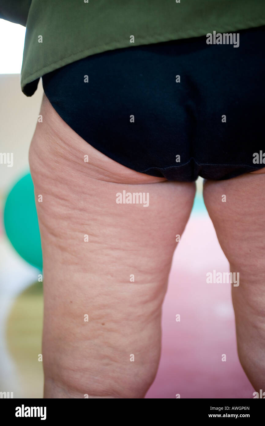 schwere Cellulite an den Oberschenkel einer Frau Stockfoto
