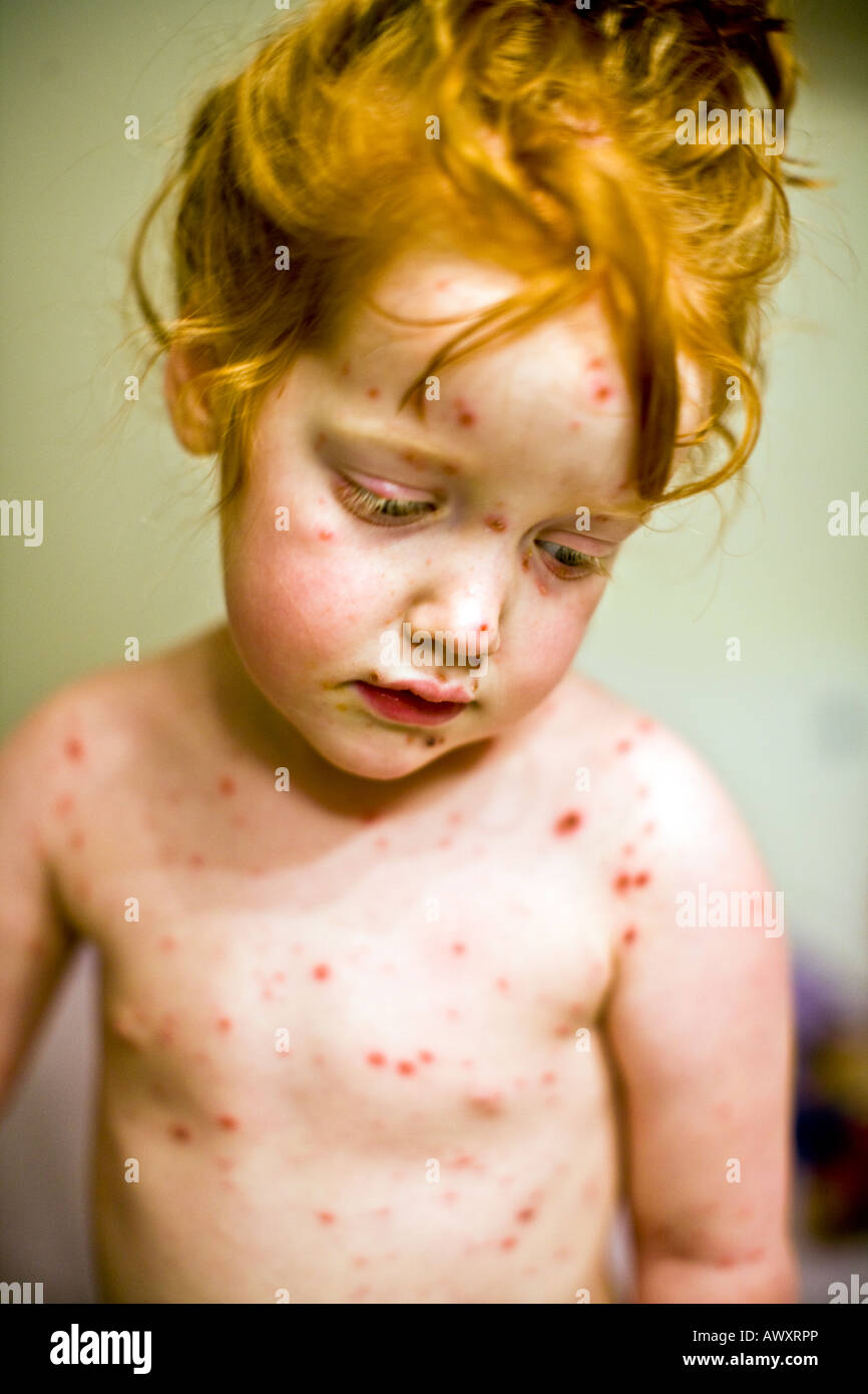 Kind Mit Hautausschlag Stockfotos Und Bilder Kaufen Alamy