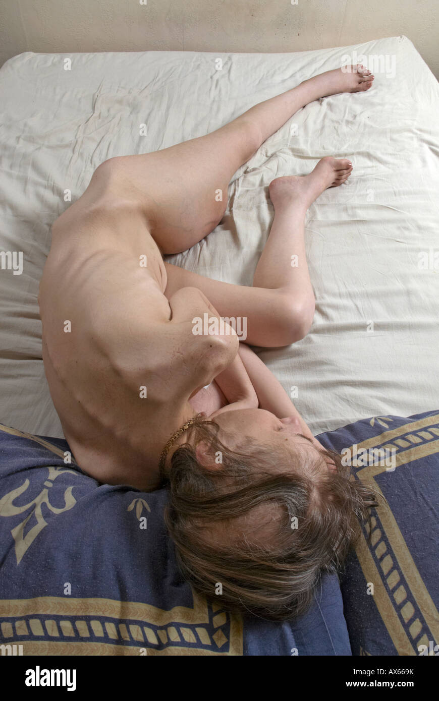Nackte Kranke Dame zusammengerollt auf dem Bett mit linken Bein mit hochwertigem Weichteilsarkomen ausgestreckt - Haarausfall durch Chemotherapie Stockfoto
