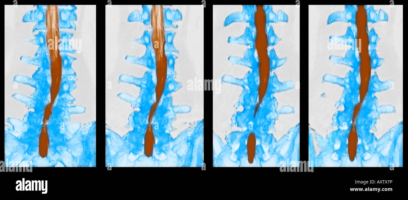 CT-Scan mit Myelogramm mit spinaler Stenose der Lendenwirbelsäule Stockfoto