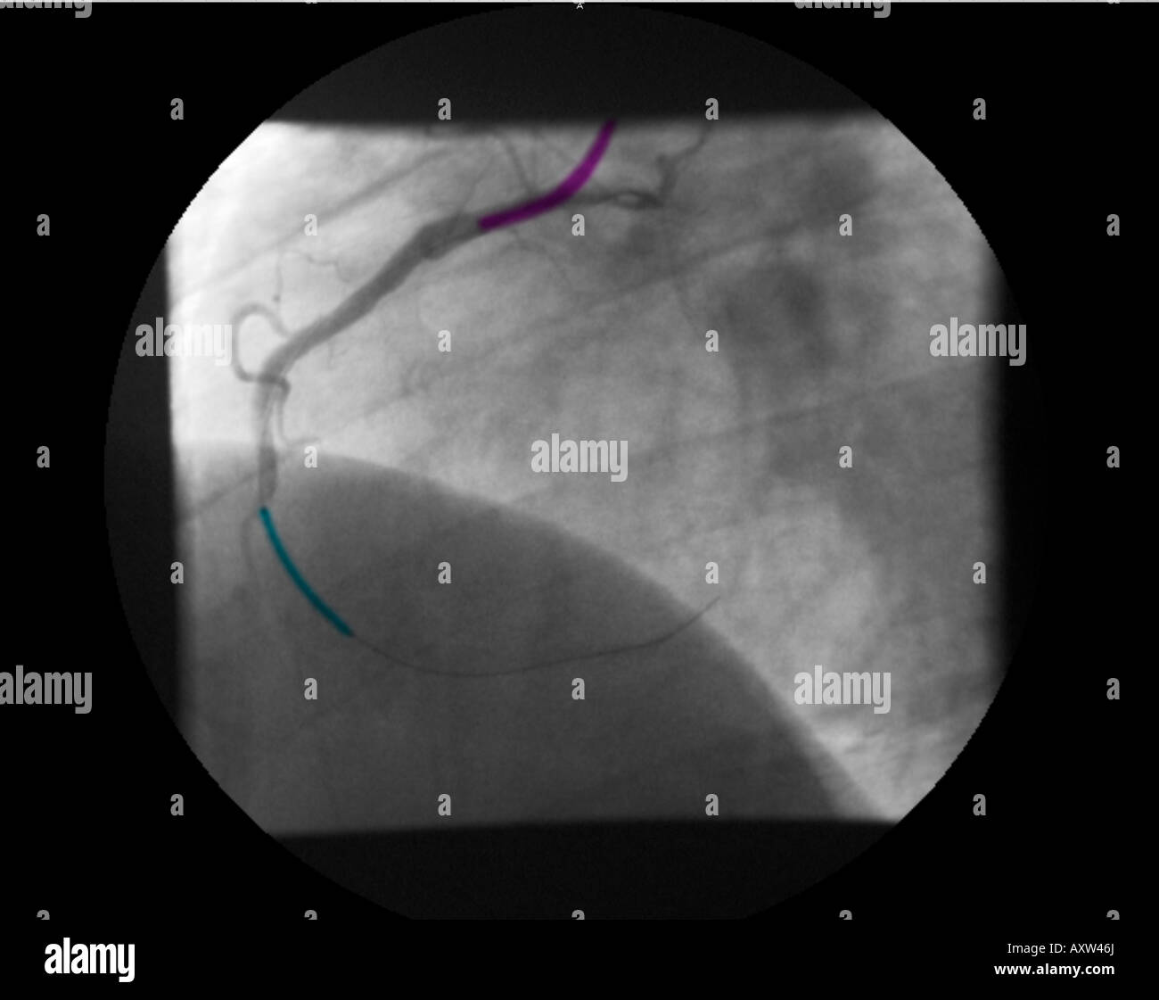 Digital erweitert, eingefärbte Röntgenaufnahme einer koronaren Angiogramm zeigt einen Stent zu öffnen, die Stenose der rechten Koronararterie Stockfoto