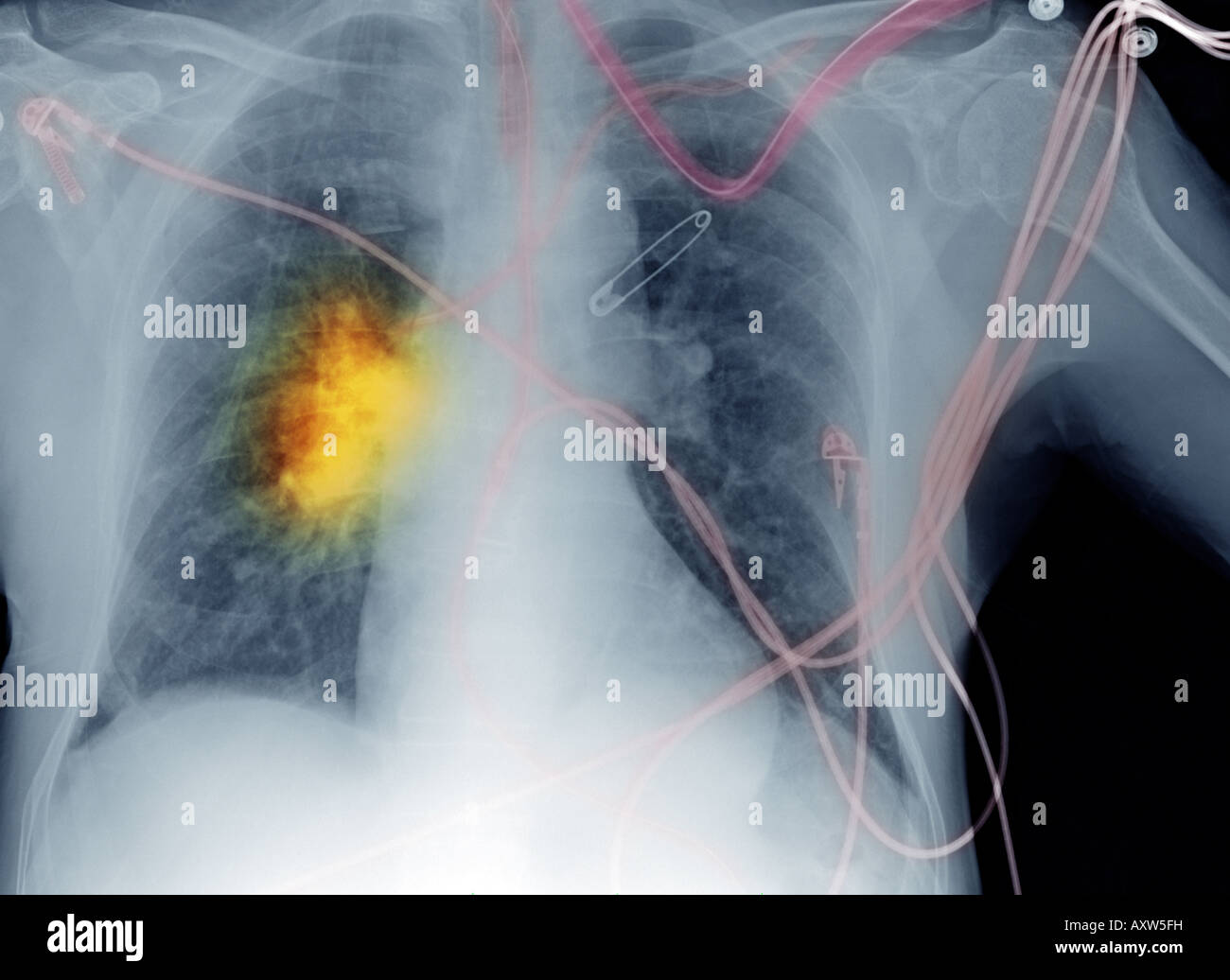 Röntgen-Thorax der ein 80 Jahre alter Mann mit einem langen Rauchgewohnheiten, der Krebs entwickelt Stockfoto