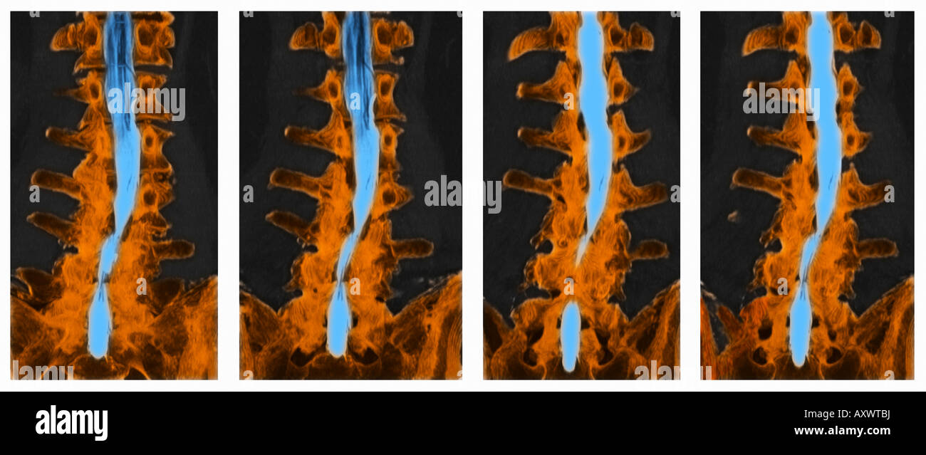 CT-Scan mit Myelogramm mit spinaler Stenose der Lendenwirbelsäule Stockfoto