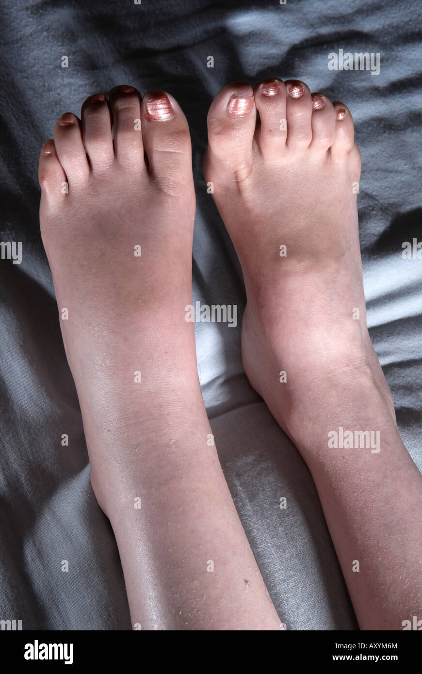 Geschwollene / geschwollene Füße, Zehen und Knöchel Erwachsenen weiblichen Frau nach einer