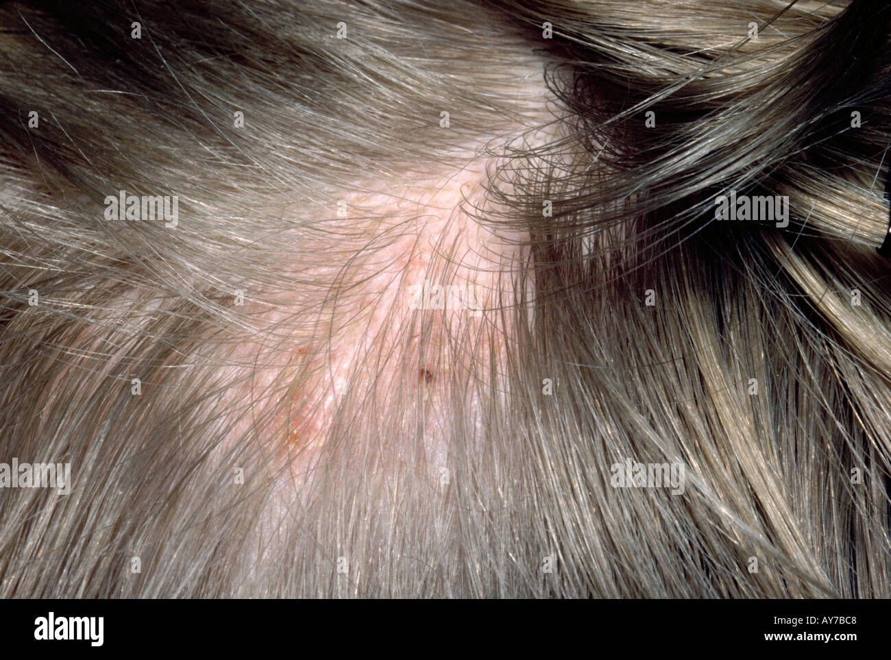 Kopfhaut Ringelflechte Stockfotos Und Bilder Kaufen Alamy