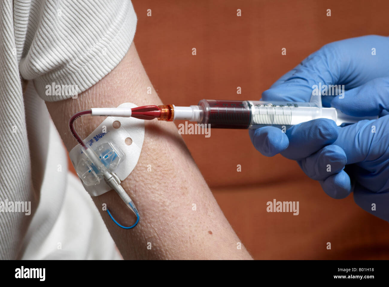 Blutentnahme aus einer Picc Linie mit OP-Handschuhen (peripher zentrale  Katheter Stockfotografie - Alamy