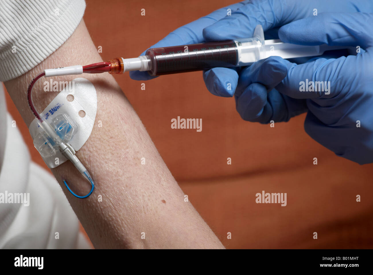 Blutentnahme aus einer Picc Linie mit OP-Handschuhen (peripher zentrale Katheter) Stockfoto