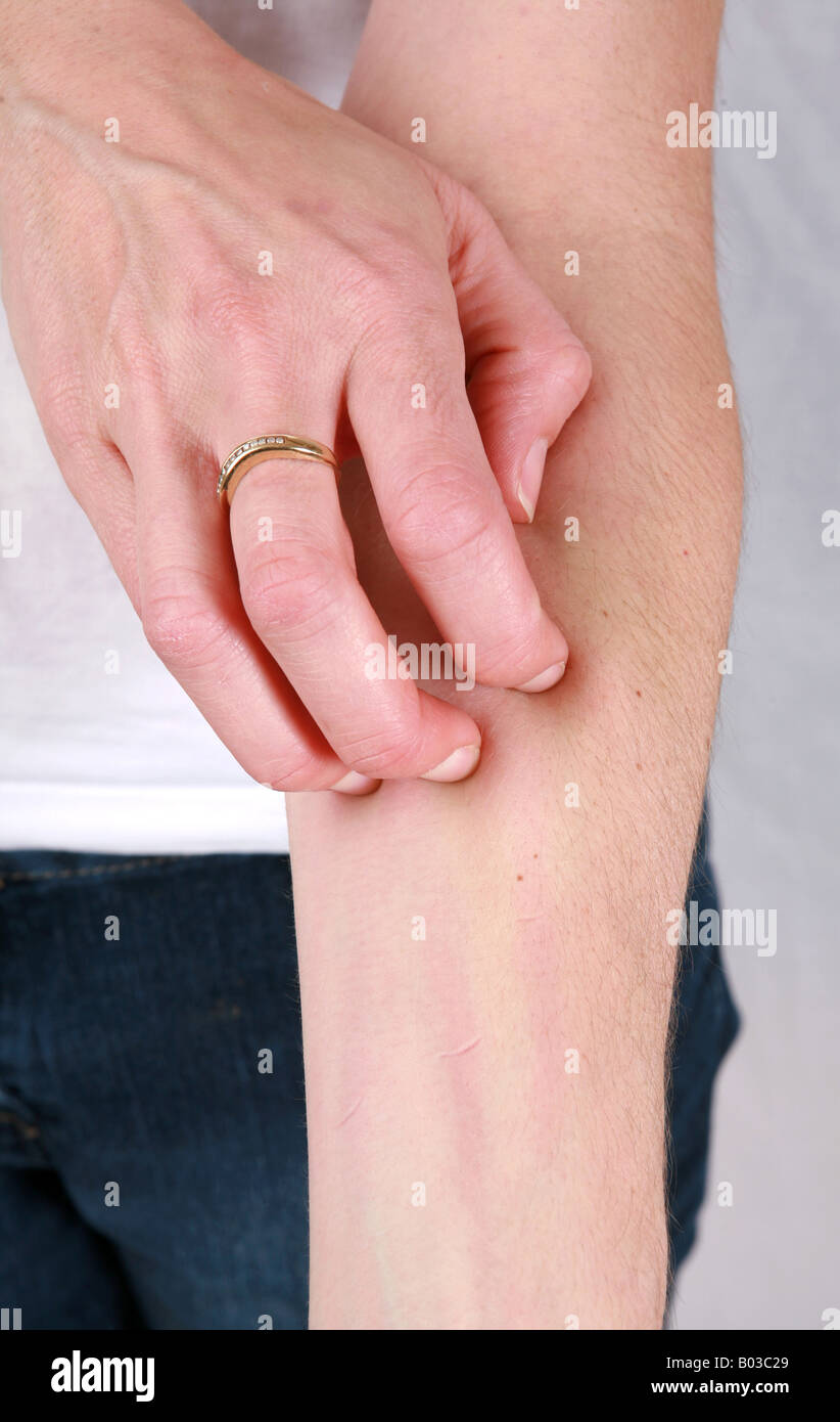 Nesselsucht hautzustand Fotos und Bildmaterial in hoher Auflösung Alamy