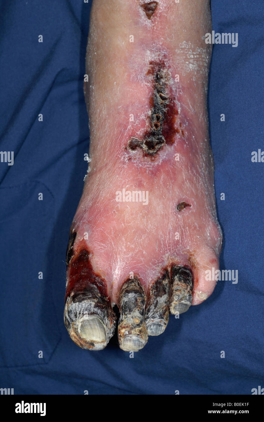 77 Jahre alte Diabetiker männlich mit einem gangränöse Fuß schlecht durchblutet Stockfoto