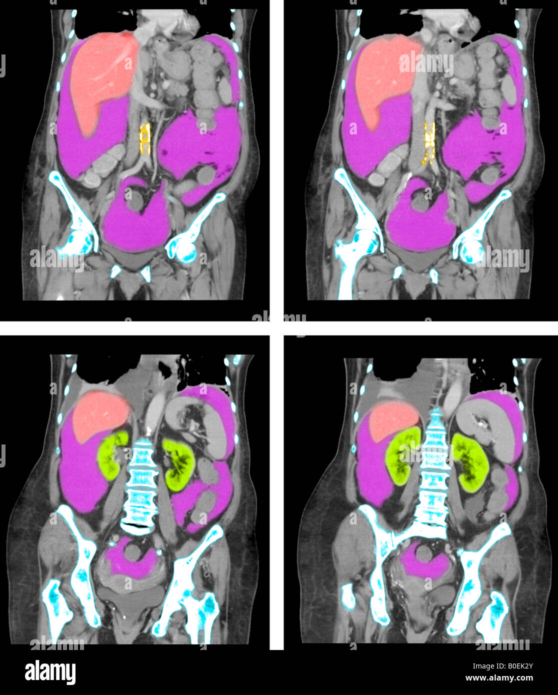 CT des Abdomen und Becken der 77 Jahre alte Frau mit Krebs Stockfoto