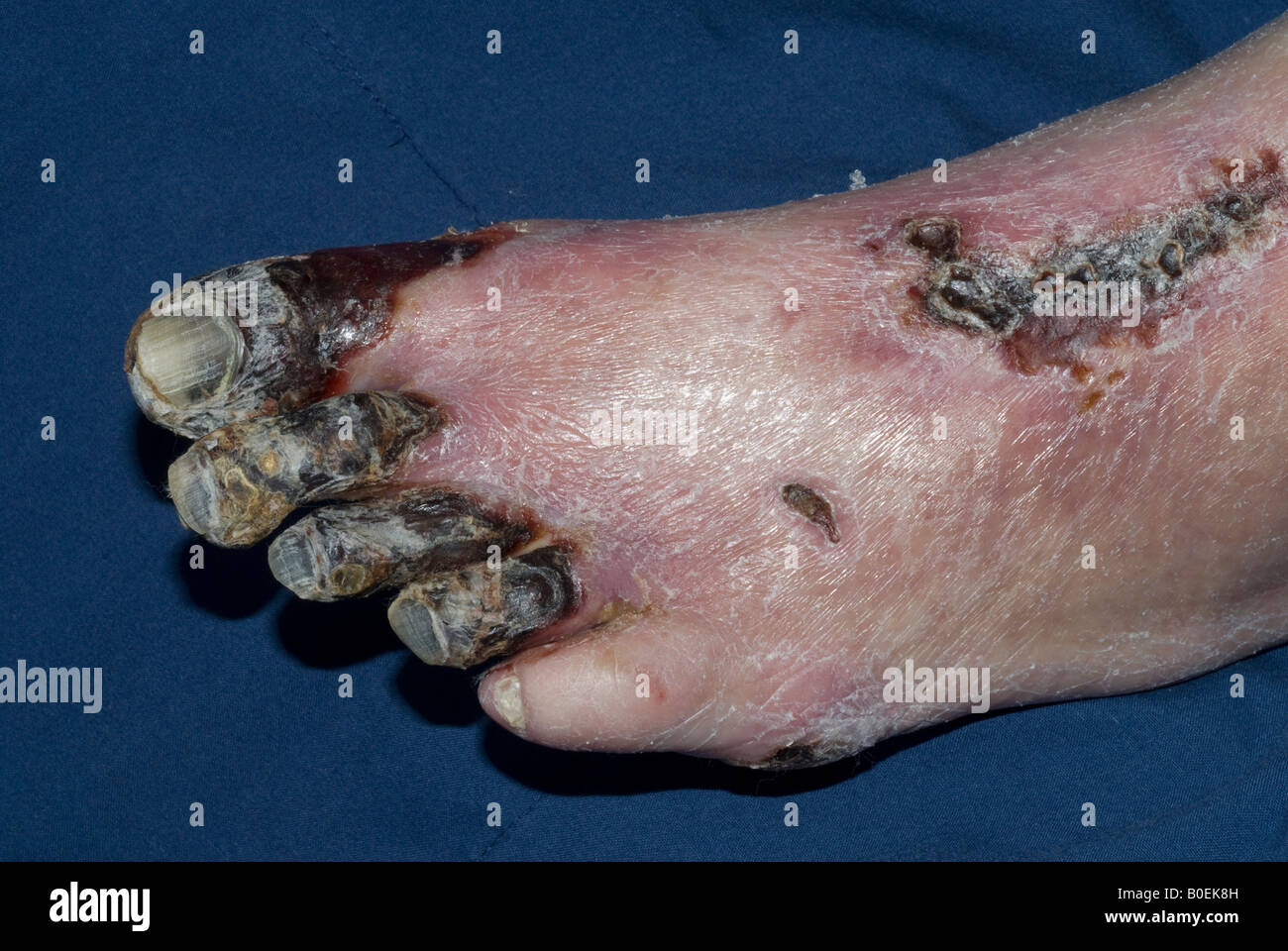 77 Jahre alte Diabetiker männlich mit einem gangränöse Fuß schlecht durchblutet Stockfoto