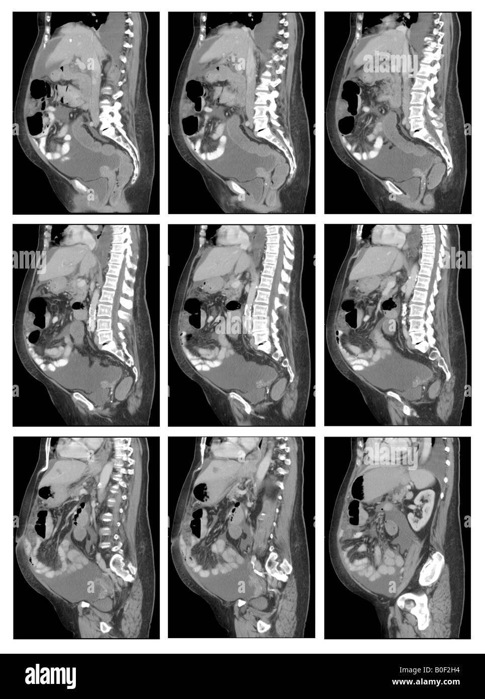 CT des Abdomen und Becken der 77 Jahre alte Frau mit Krebs Stockfoto