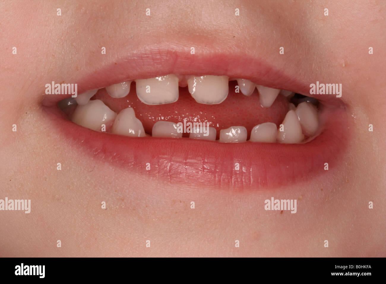 Schlechte Zähne Stockfoto