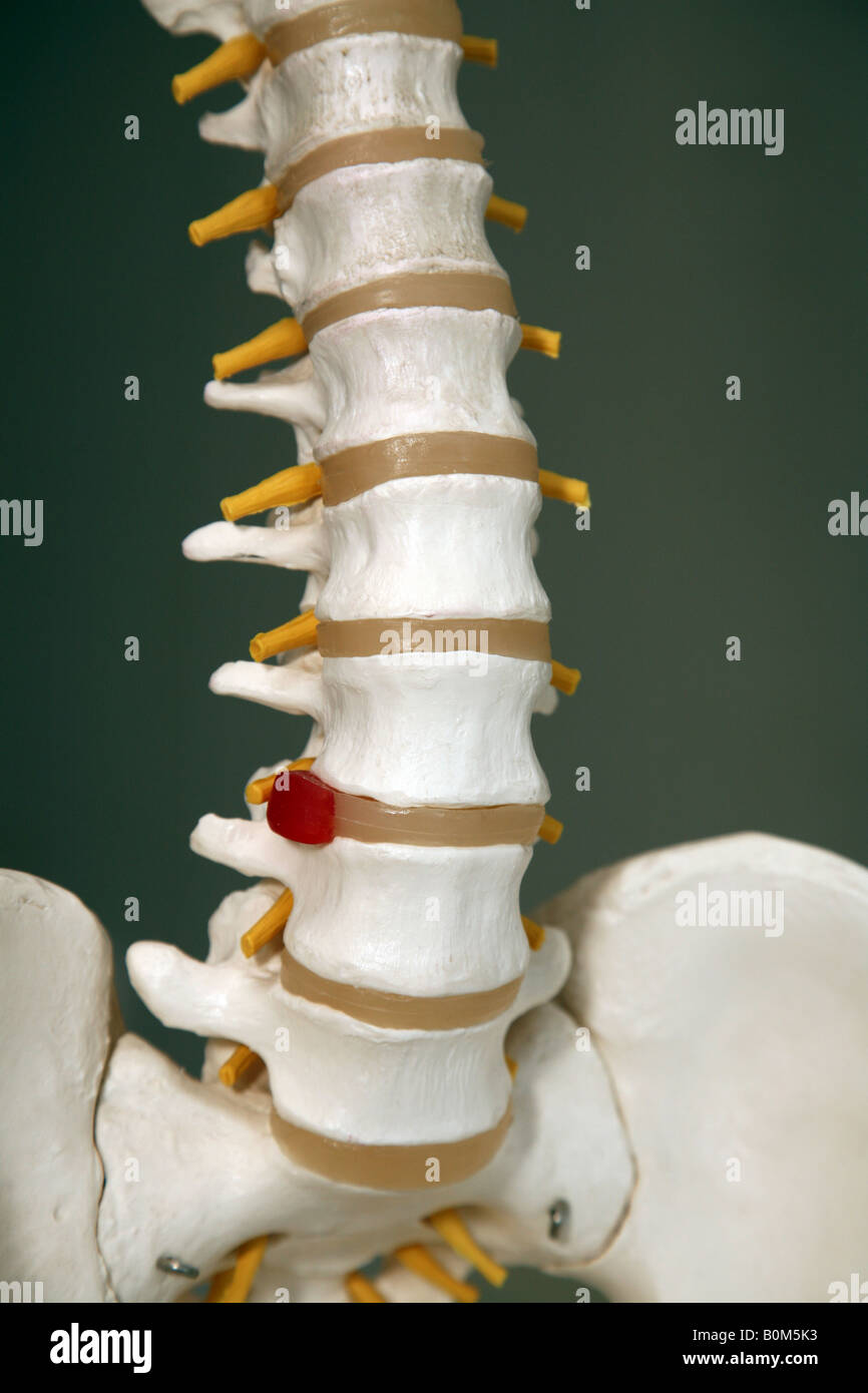Ein Modell einer Lendenwirbelsäule zeigt eine beschädigte Bandscheibe Stockfoto