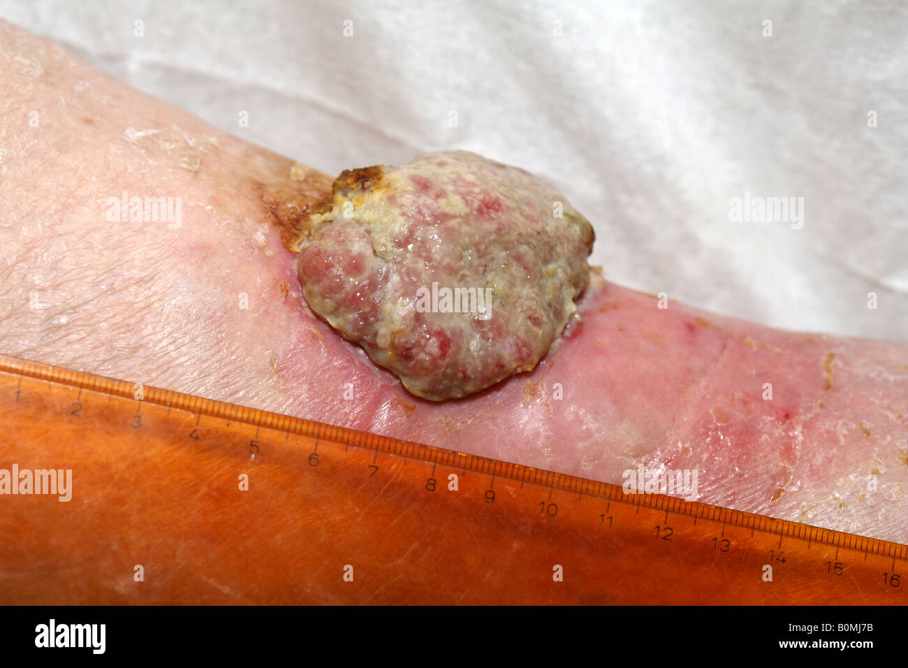 Ein 5cm malignen Plattenepithelkarzinom (Hautkrebs) am Unterschenkel einer älteren Frau Stockfoto