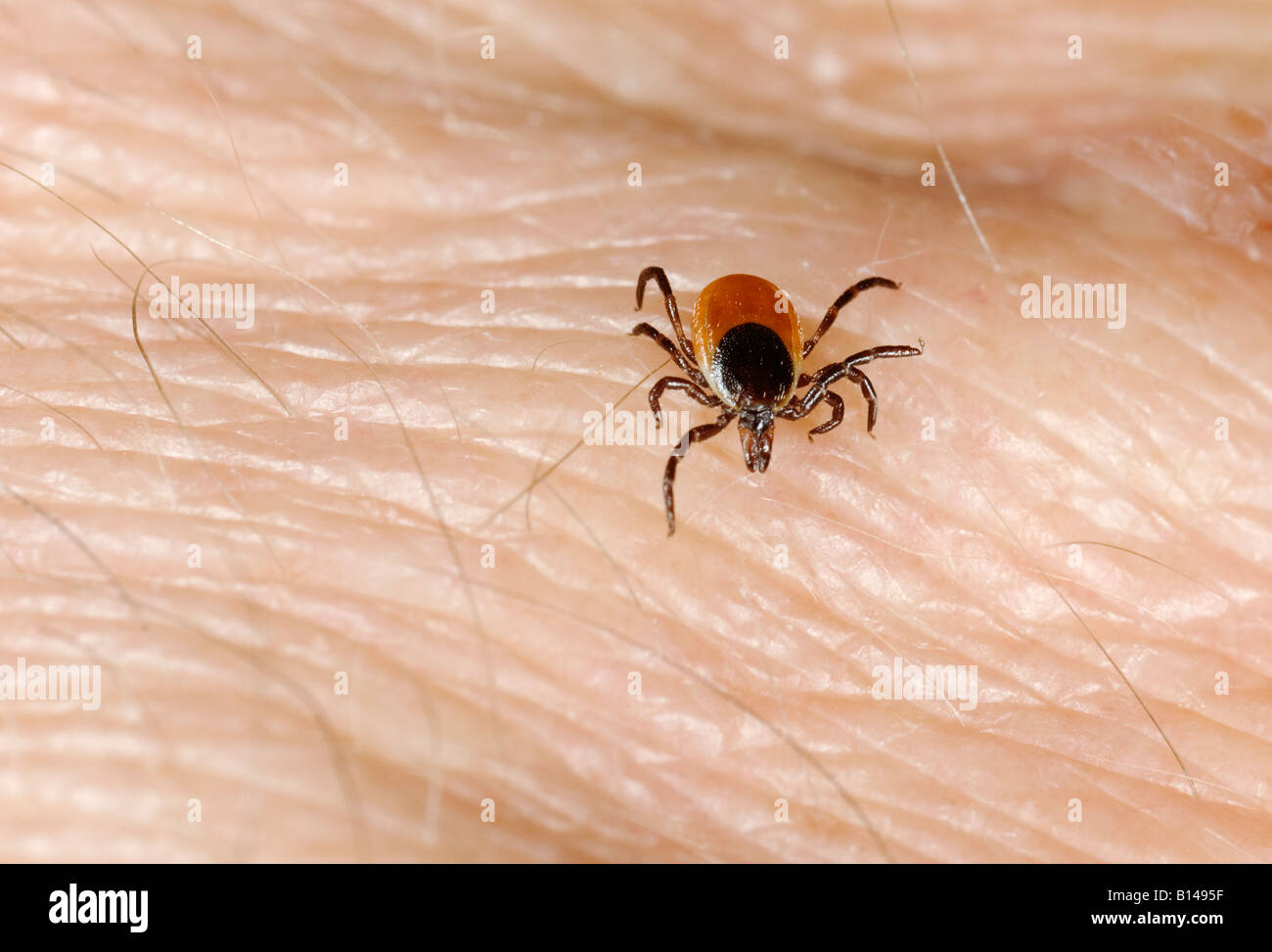 Ixodes Scapularis Rotwildhäckchen auf der menschlichen Haut Stockfoto