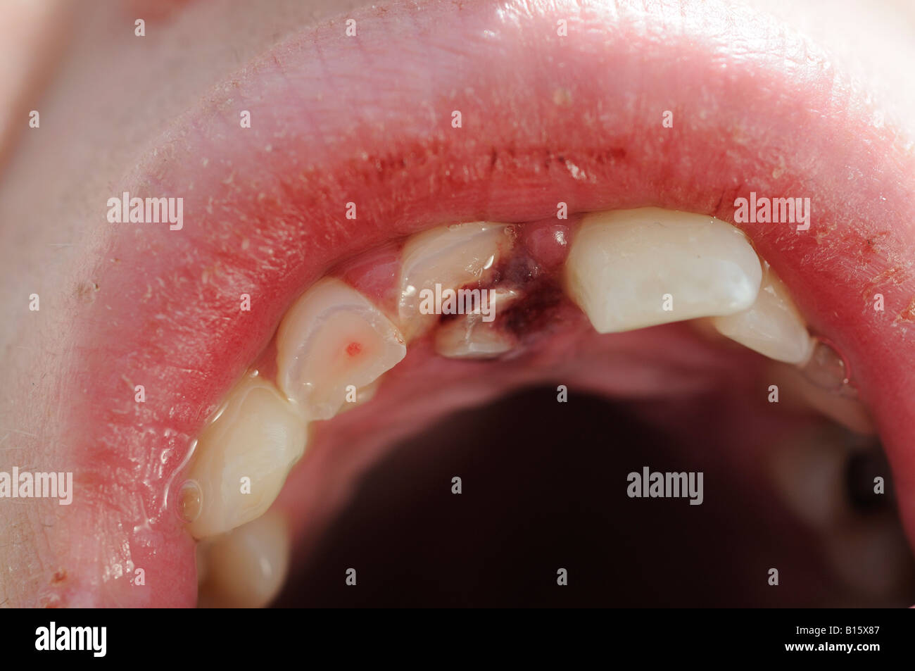 Gebrochene Zähne und spaltete sich Lippe nach angegriffen in der Bar Stockfoto