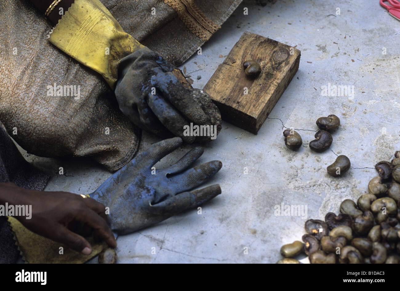 Cashew-Nuss, die Verarbeitung der Muttern verströmen eine Säure, die die Arbeiter Finger verbrennt Stockfoto