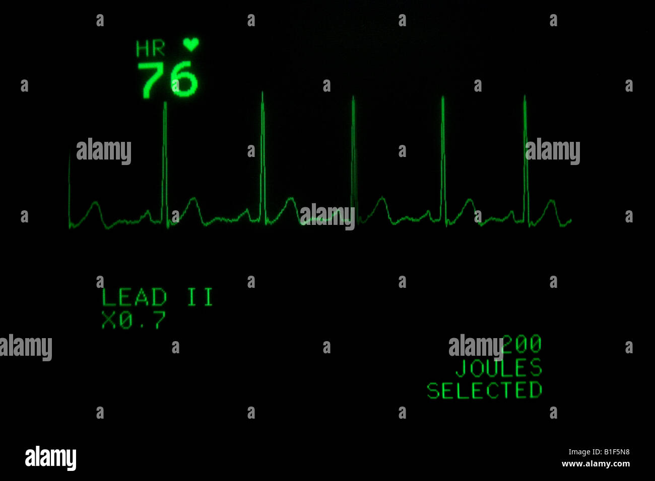 EKG monitor Anzeige der Herzfrequenz Stockfoto