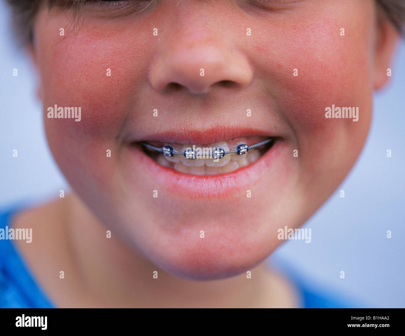 USA Vereinigte Staaten An 11 Jahre altes Mädchen zeigt ihre erste Reihe von Zahnspangen Stockfoto