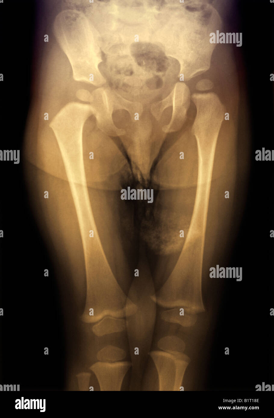X-ray 23 Monate alten männlichen Beckens Stockfoto