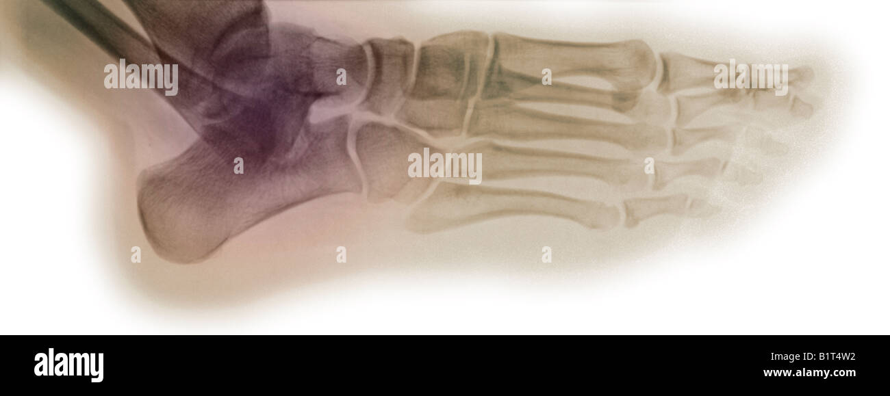 Röntgenaufnahme des 20 Jahre alten Mannes Knöchel und Fuß Stockfoto