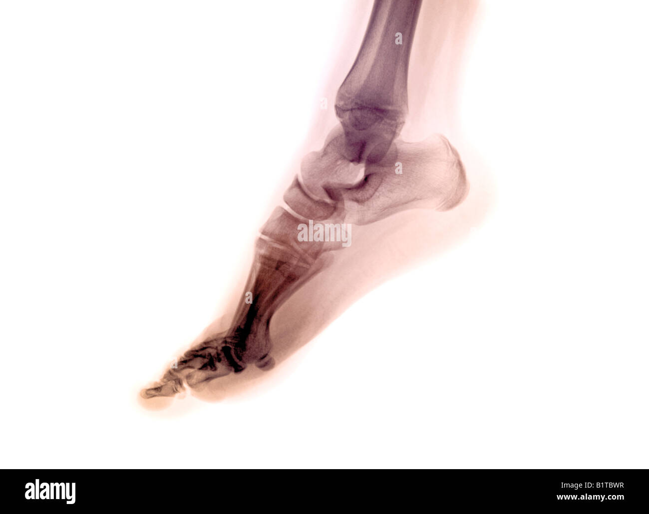 X-ray 11 Jahre alt weiblich Fuß Stockfoto