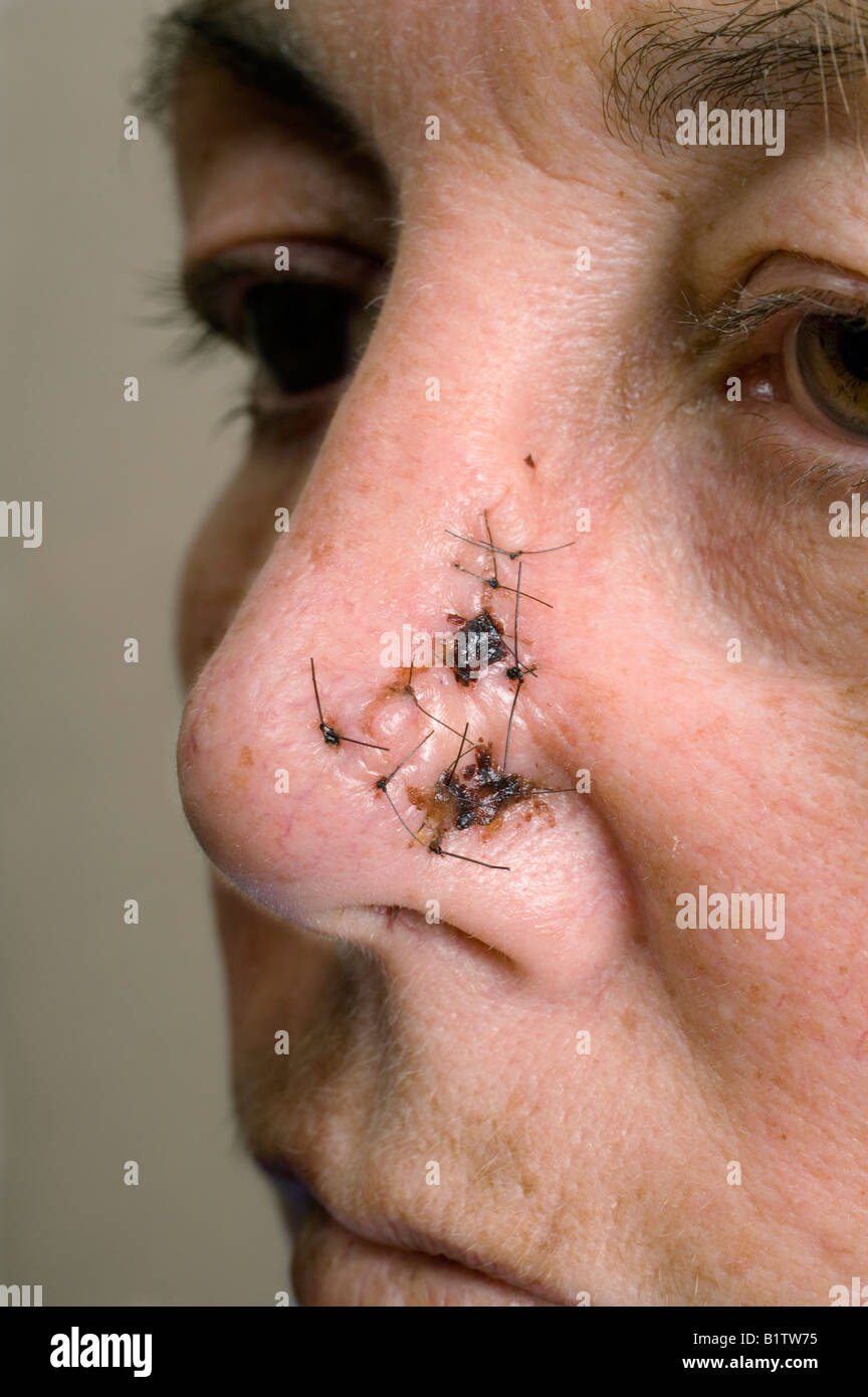 Vier Tage nach der Operation auf eine Nase, ein Basalzell-Sarkom zu entfernen Stockfoto