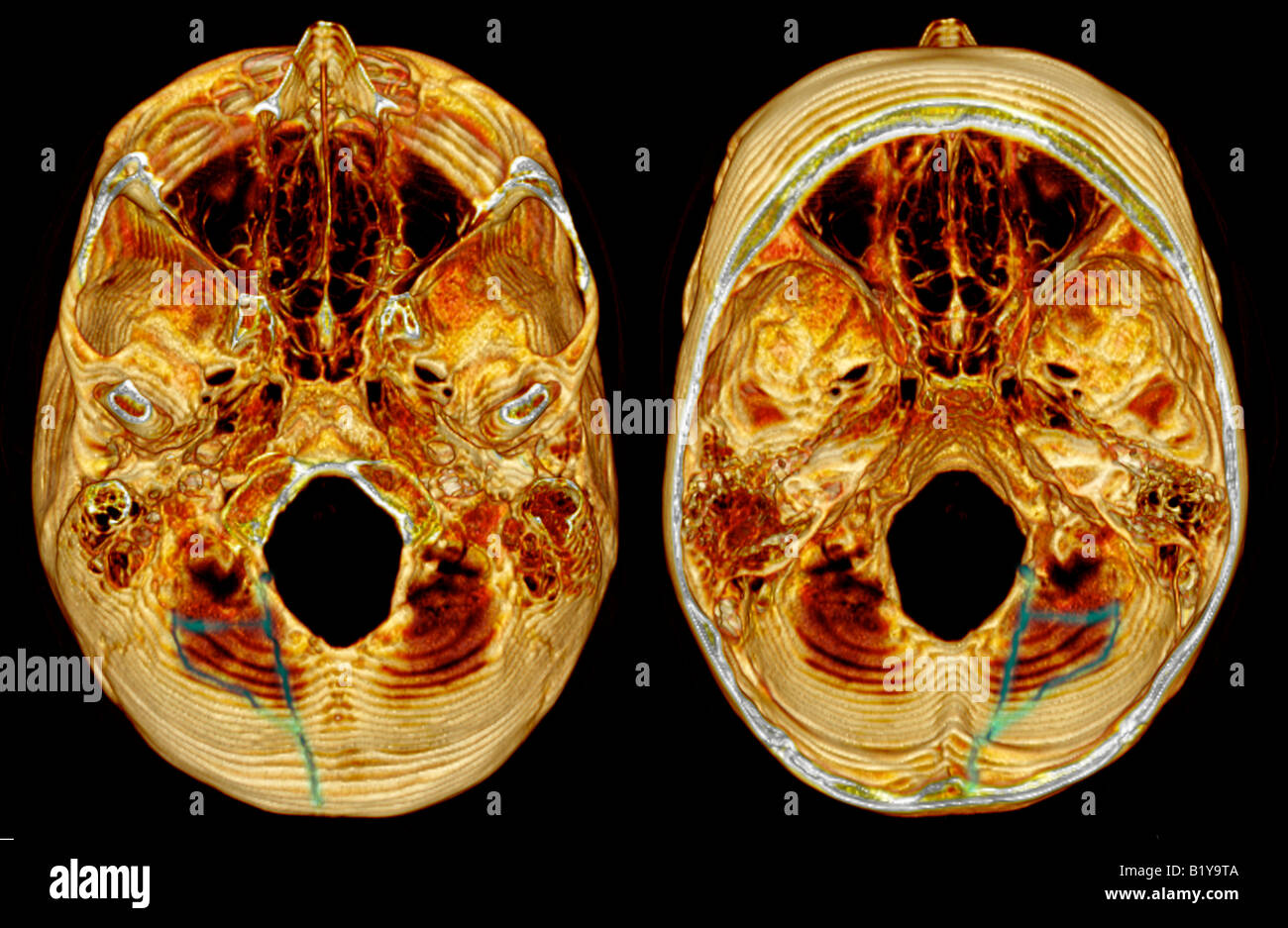 3D CT-Rekonstruktion der einen okzipitalen Schädelbruch Stockfoto