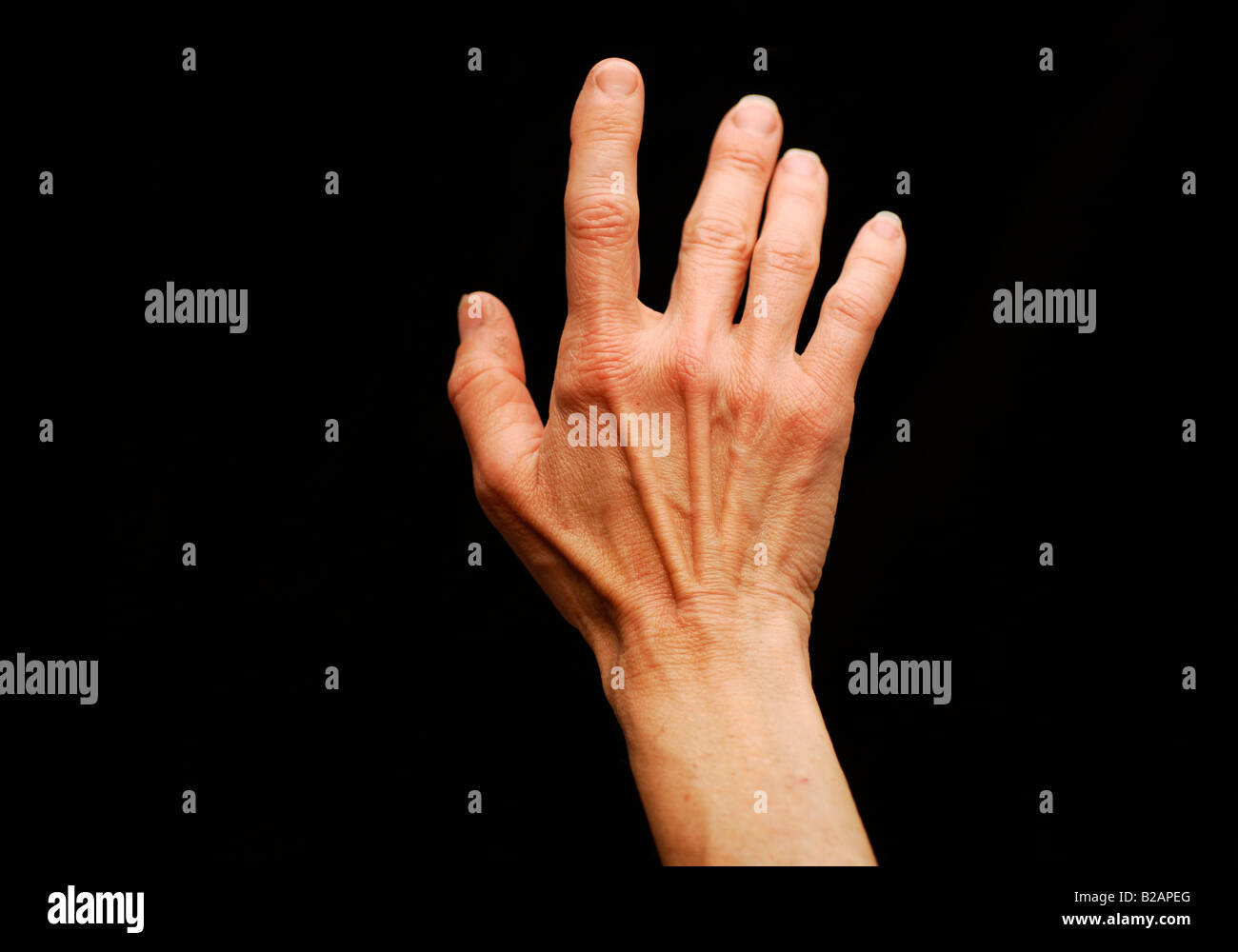 59-j hrige Frauenhand, Symptome von arthritis Stockfoto