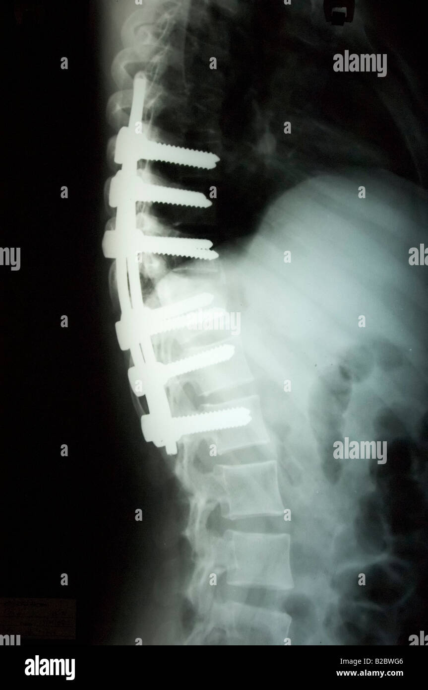 Röntgenaufnahme der Wirbelsäule nach einer Operation im Zusammenhang mit spinalen Tuberkulose, beschädigte Wirbel mit Stahl, wi überbrückt worden sind Stockfoto