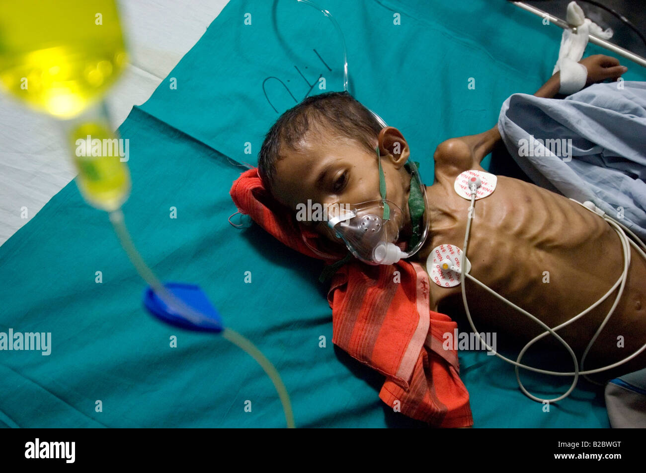 Kleine Rotique, 9, ist schwer an Tuberkulose und wurden getroffen, um die Intensivstation des Krankenhauses Shree Jain Stockfoto